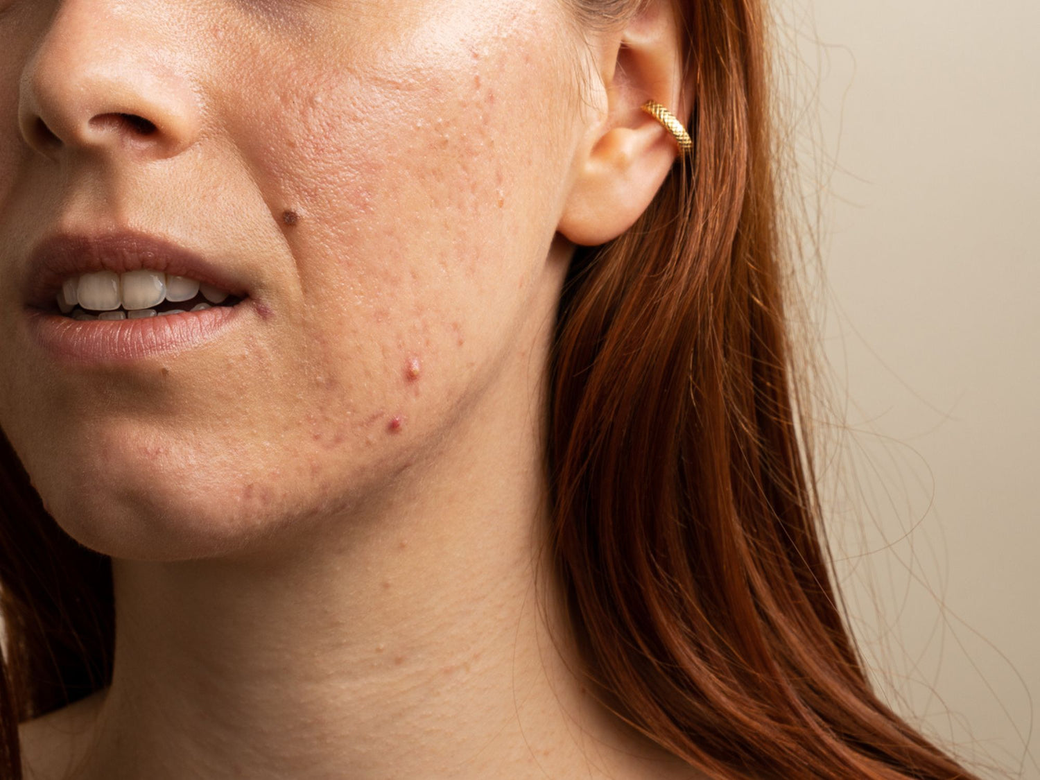 Parlons Boutons & Syndrome De L'Intestin Irritable - Skin & Out