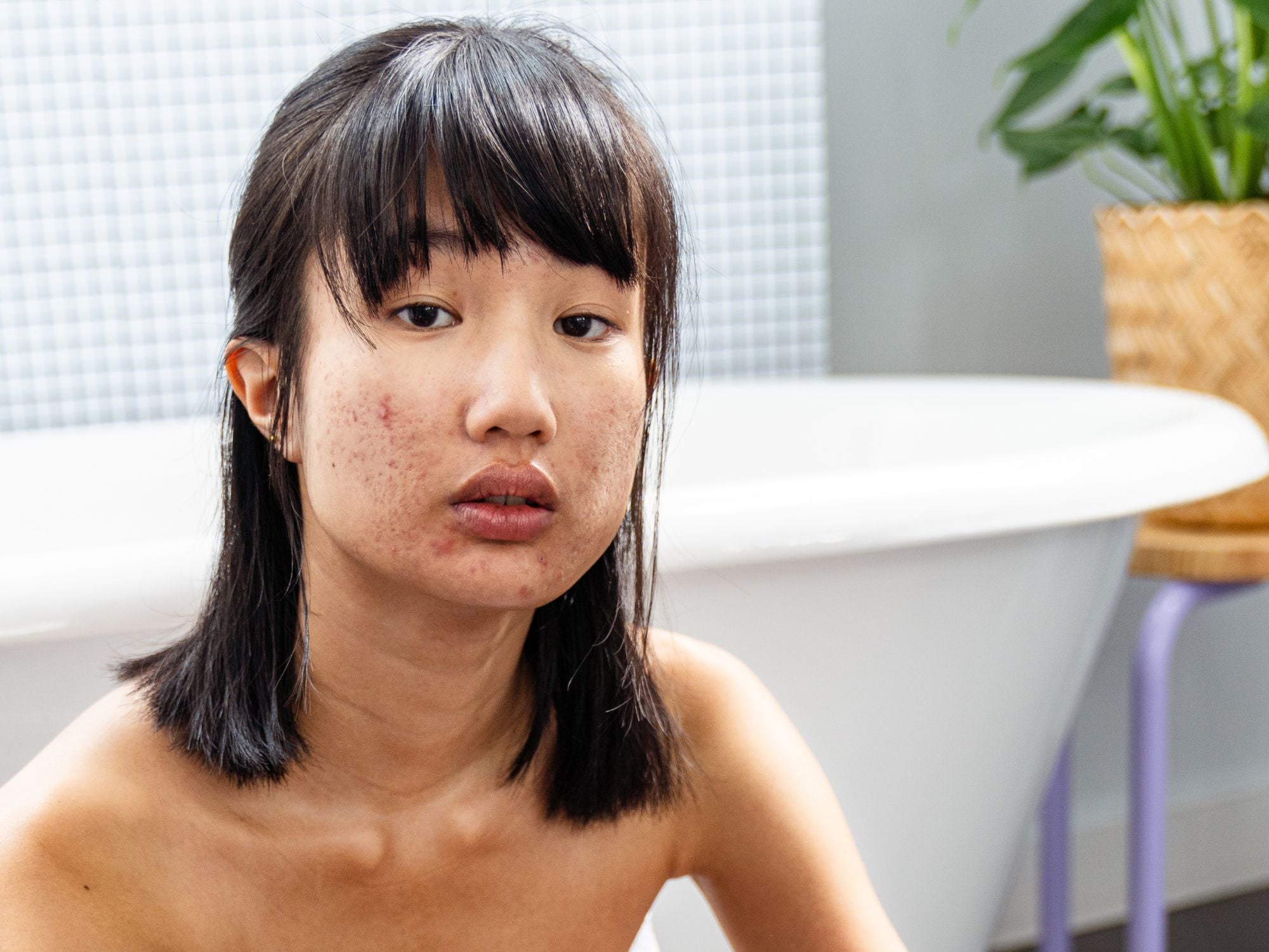 Acné et Soleil : Être Sûr que ma Crème Solaire est Ok-Acné