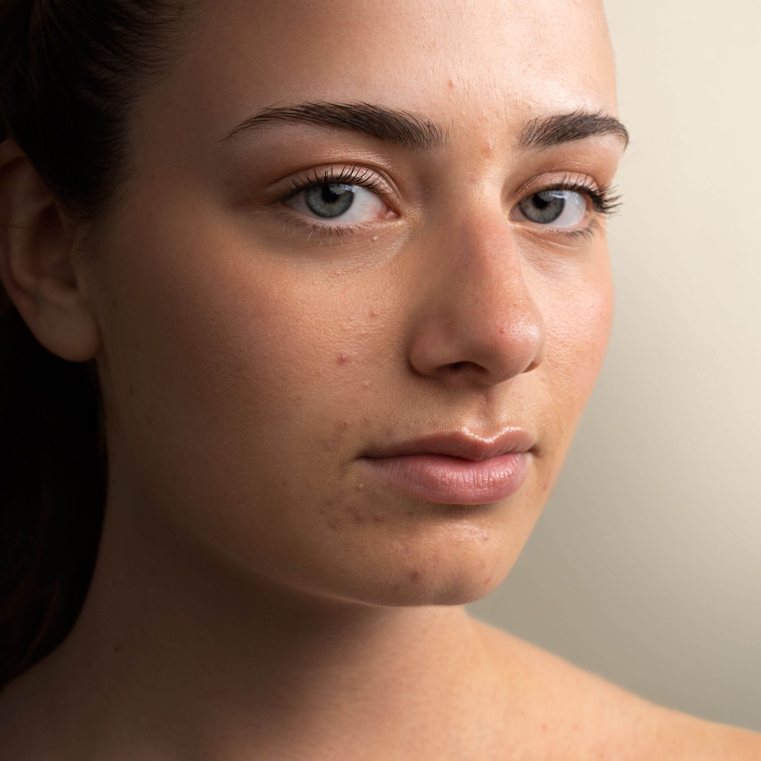 Endométriose et acné