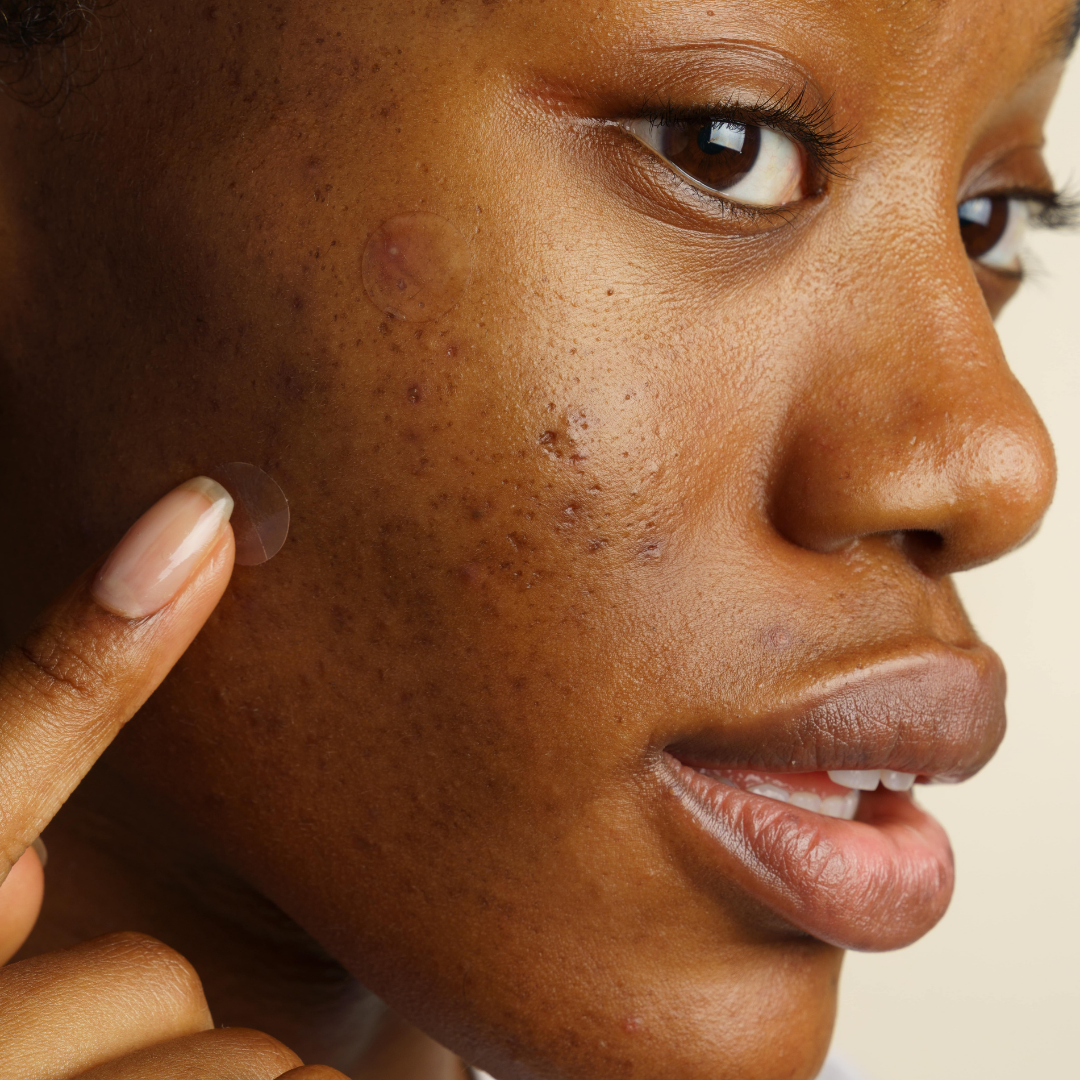 Acné adulte : Comment régulariser les hormones après l'arrêt de la pilule ?