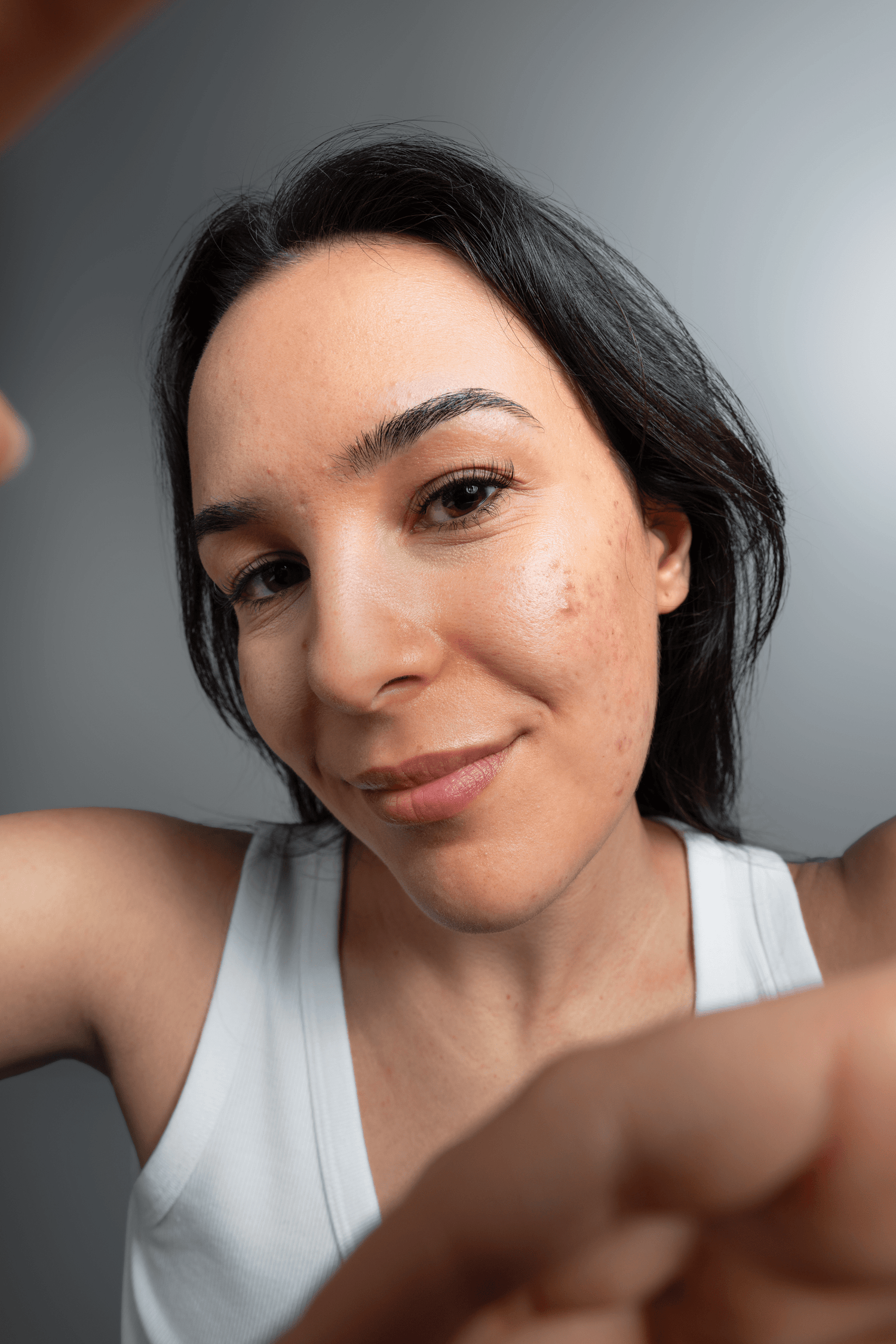 Comment éviter l’effet rebond de l’acné après tes vacances ?