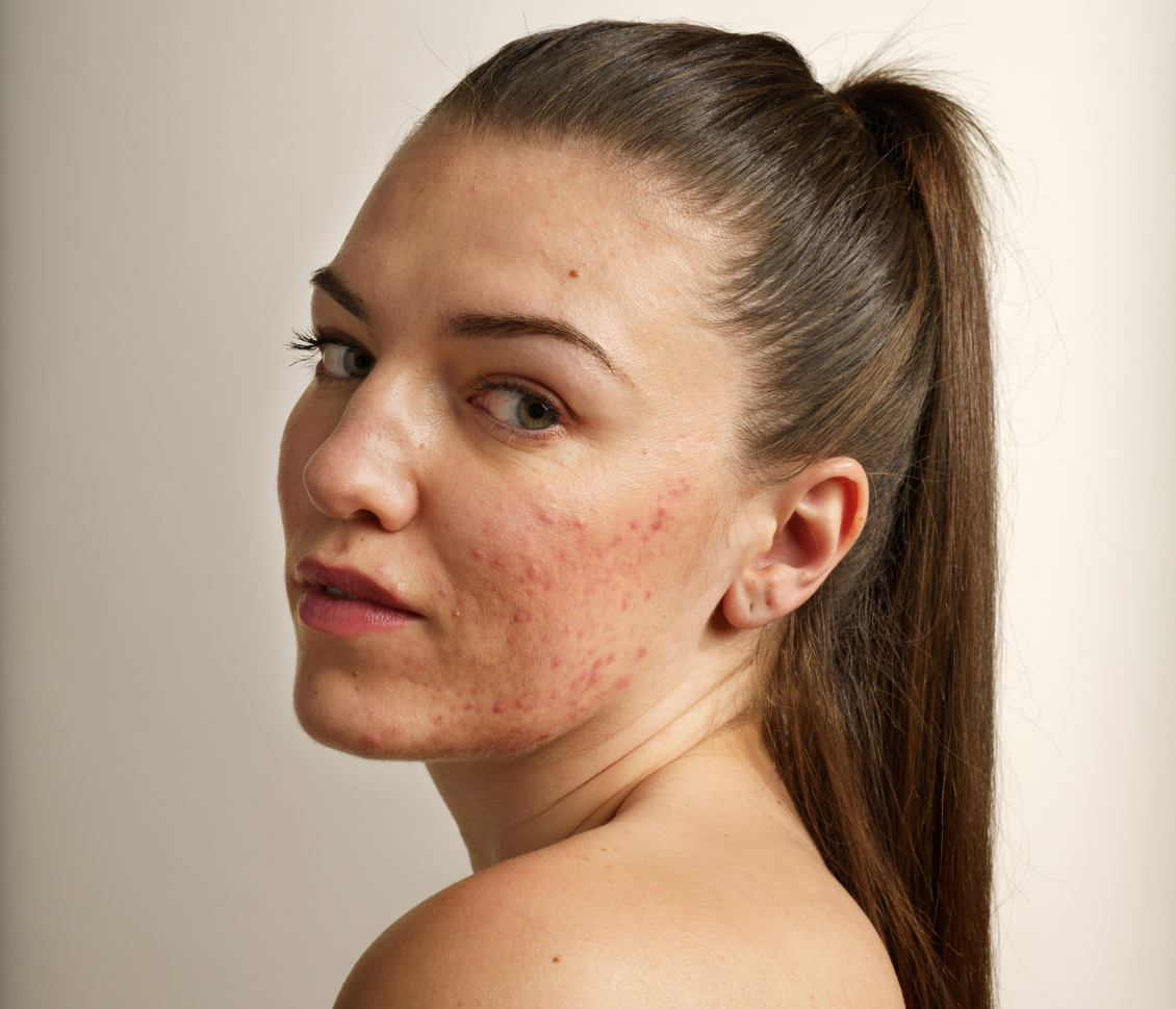 Acné et taie d'oreiller en soie