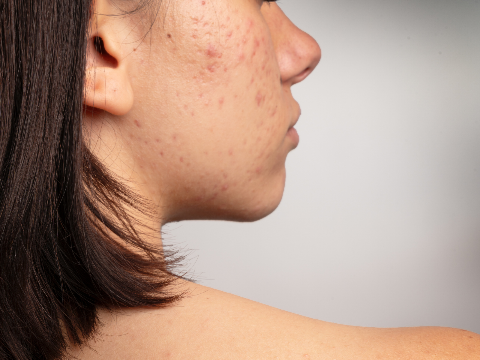 L'acné microkystique hormonale : causes et solutions naturelles