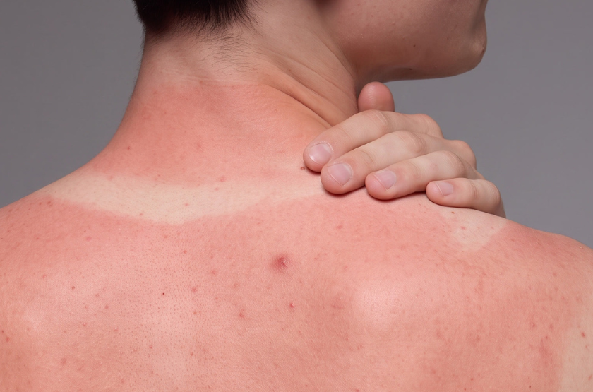 3 hacks pour calmer tes boutons après une exposition au soleil ☀️