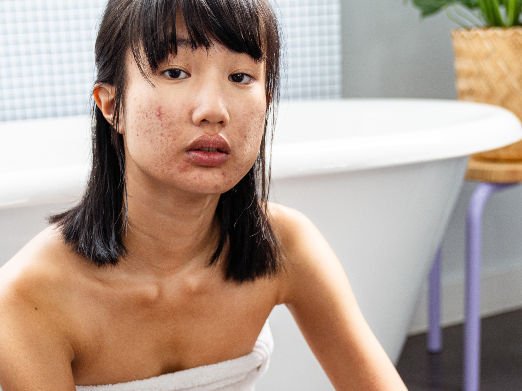 acne exfoliation