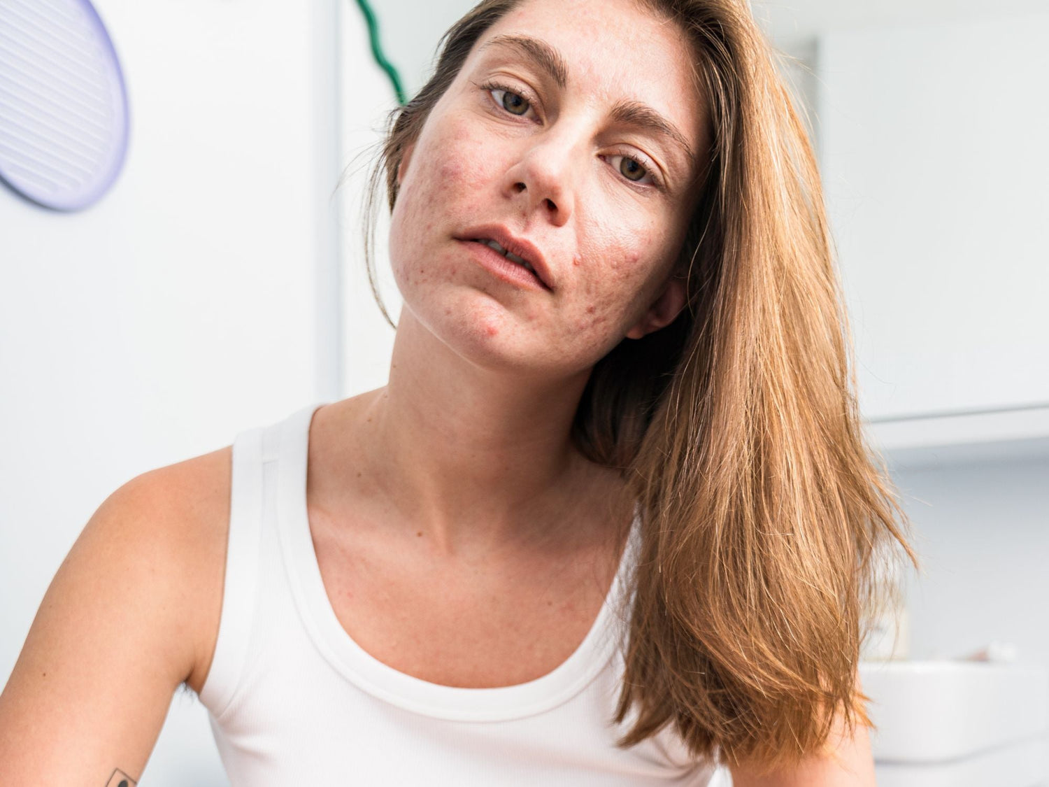 Arrêt Pilule & Acné - Skin & Out