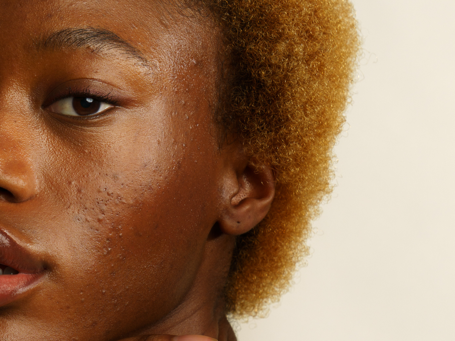 Pourquoi notre cycle menstruel, caractérisé par des variations hormonales, peut avoir des impacts sur la peau et notamment sur les boutons ? À quoi est liée l'acné au moment des règles ? Comment la limiter ?