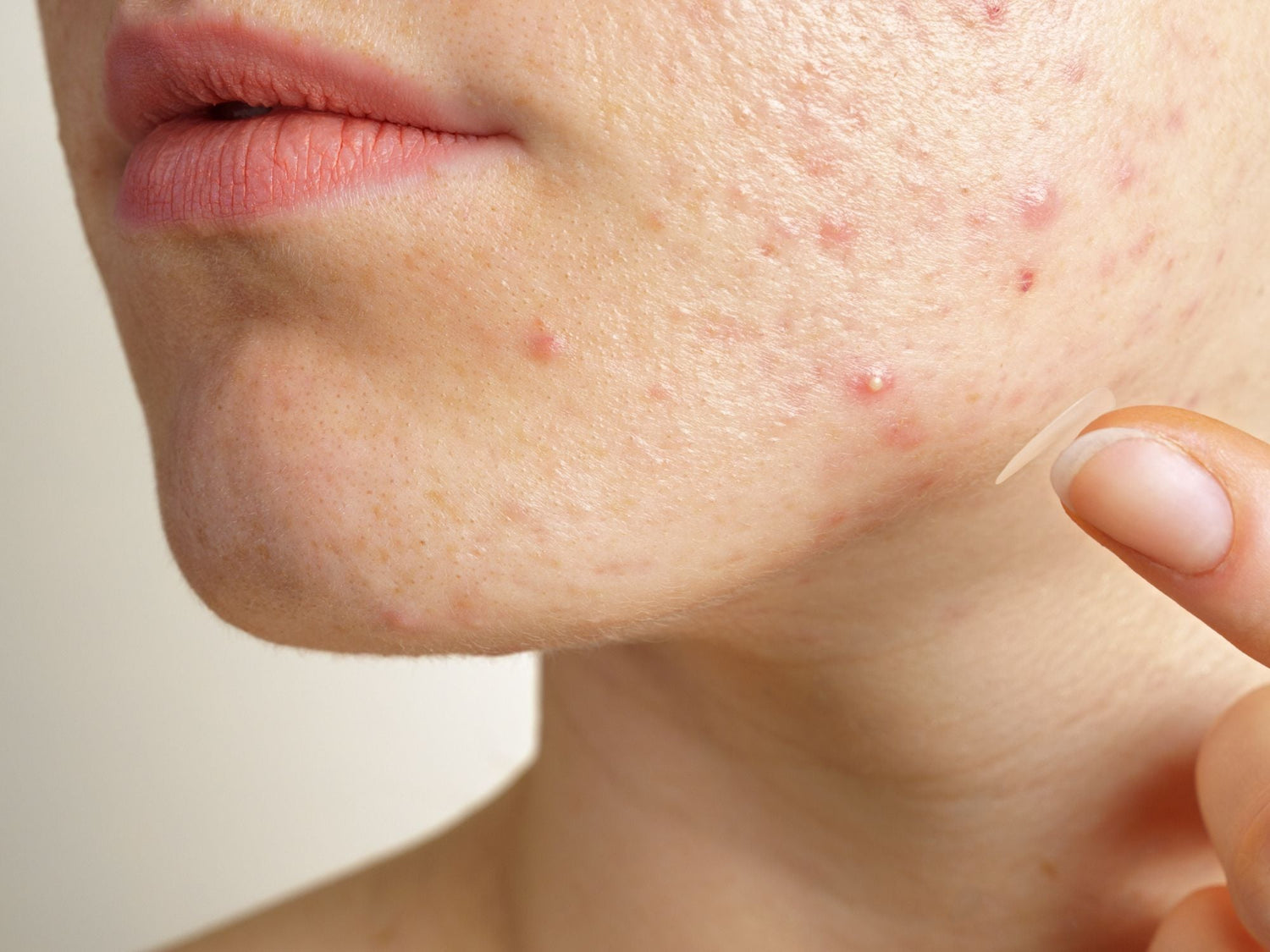 Dans ce guide on te donne toutes nos recommandations pour percer un bouton correctement pour éviter les cicatrices liées à l'acné.