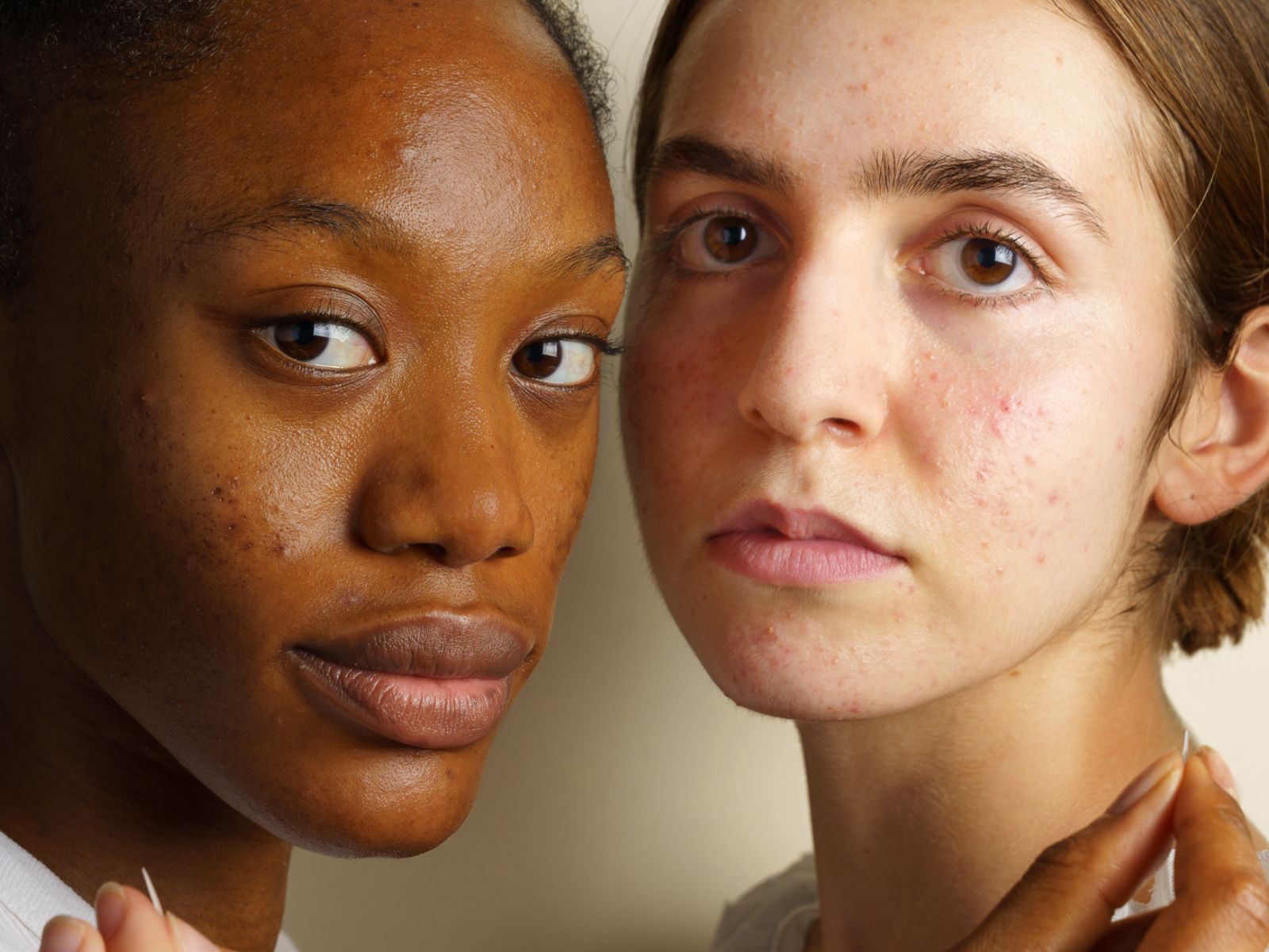 Pilule et Acné - Skin & Out