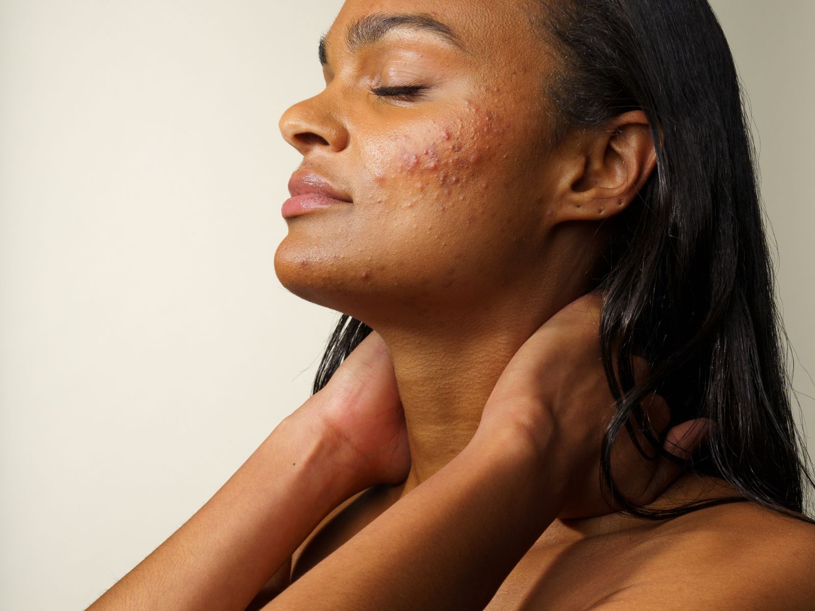 Acné inflammatoire - Skin & Out
