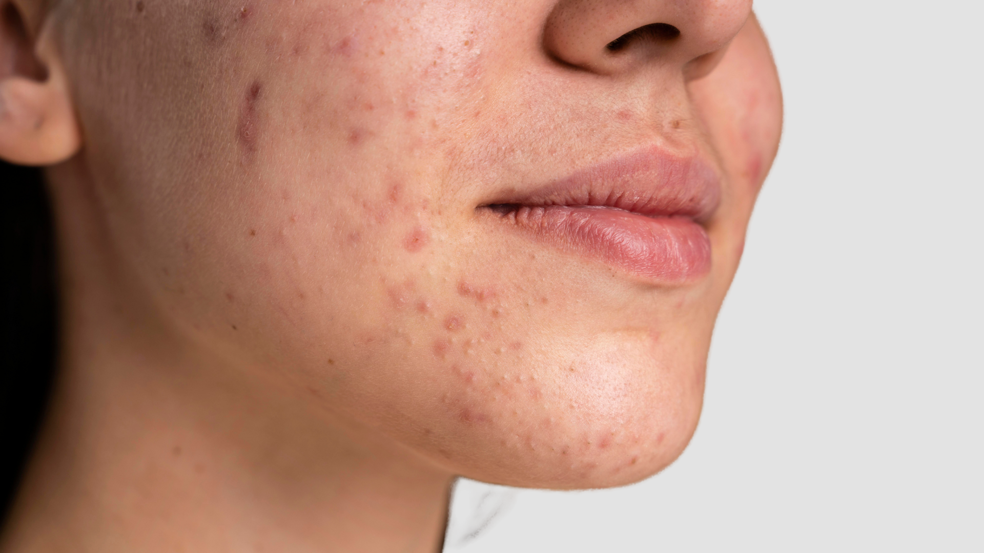 Bakuchiol VS Retinol : Que choisir ?