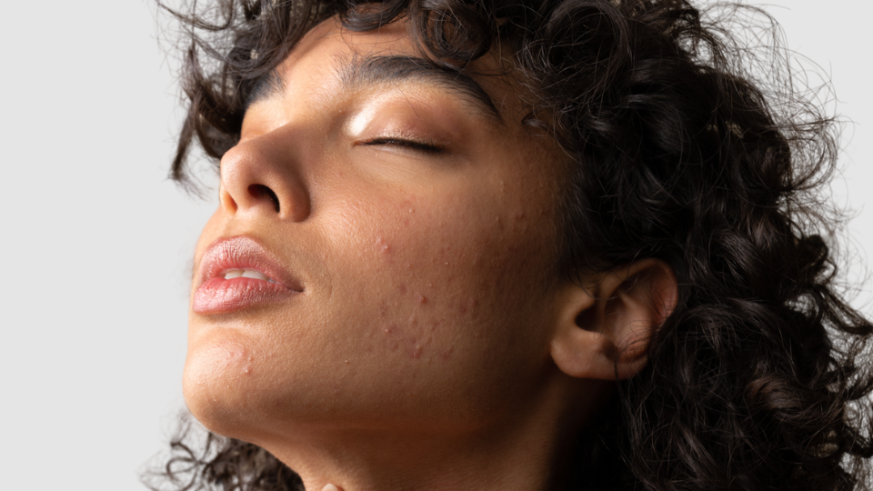 Parlons boutons avec Dermato Drey
