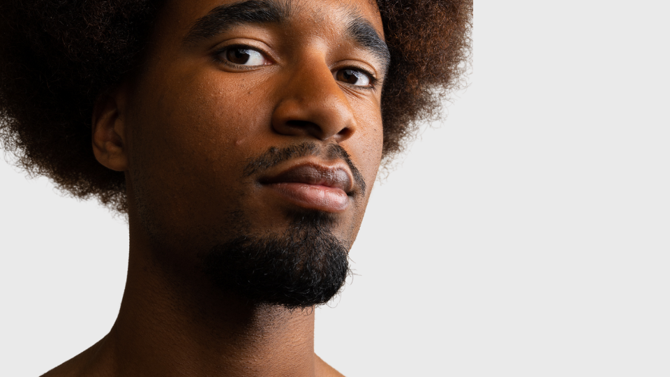 L’acné hormonale chez l’homme