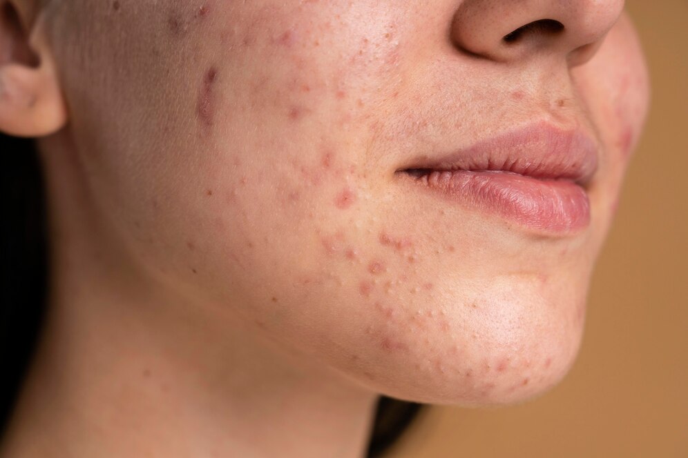 Comment éviter les cicatrices d'acné ?