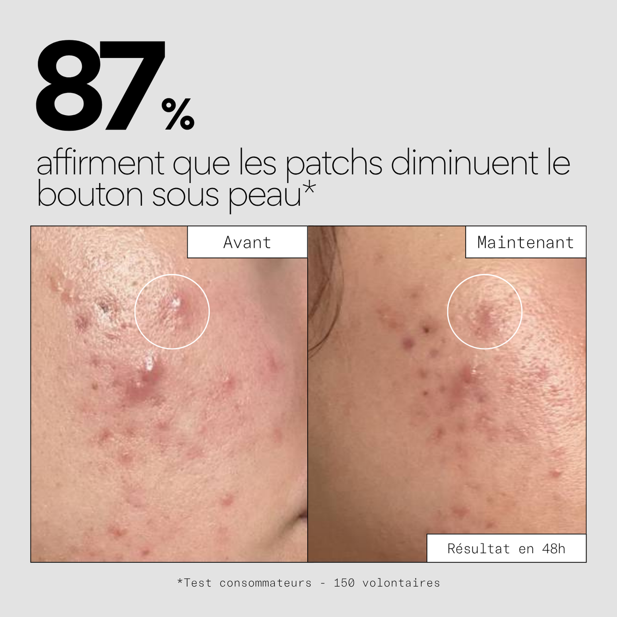 Clear OUT - Patchs boutons sous-cutanés micro-aiguilles x9