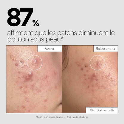 Clear OUT - Patchs boutons sous-cutanés micro-aiguilles x9