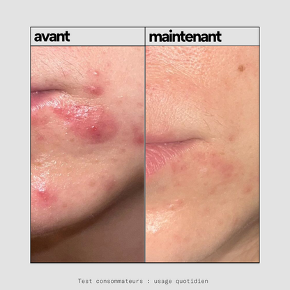 Routine SOS acné inflammatoire