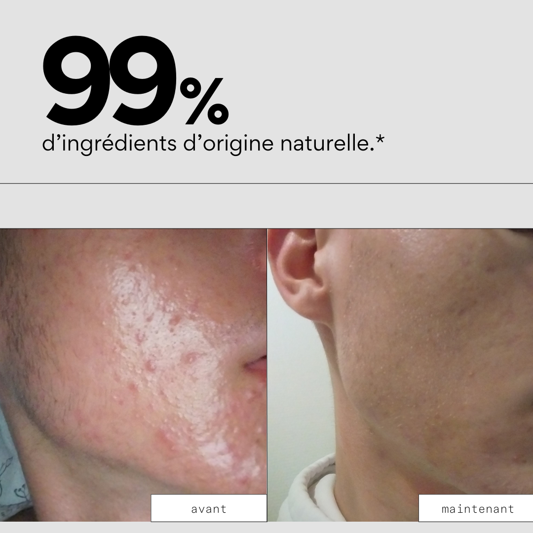 Routine OUT - Routine skincare anti-acné