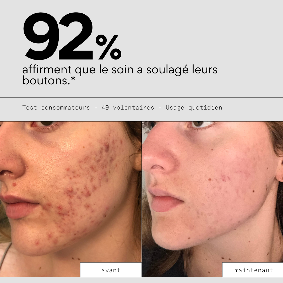Clear OUT - Soin ciblé stop-boutons