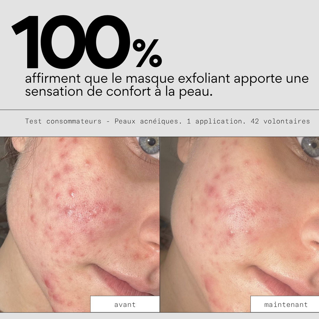 Peel OUT - Routine SOS points noirs et pores