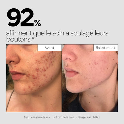 Clear OUT - Soin ciblé stop-boutons