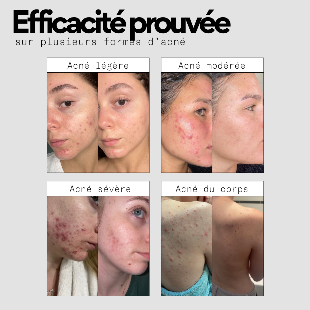 Routine IN - Cure 3 mois compléments alimentaires anti-acné