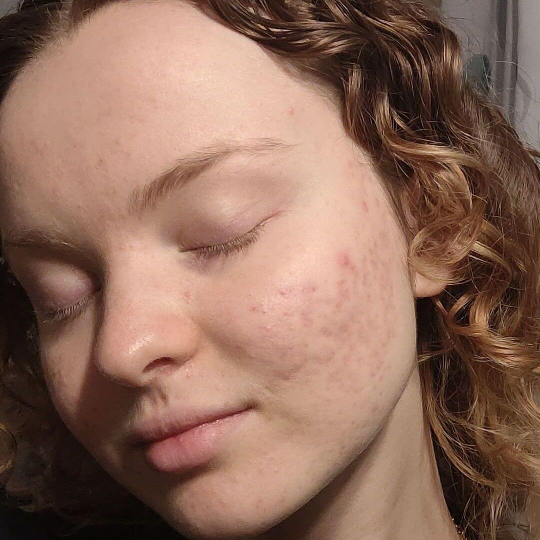 Témoignage acné 